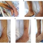skin and skin structure klebsiella infection