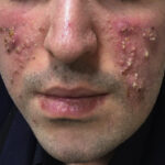 skin and skin structure morganella morganii infection