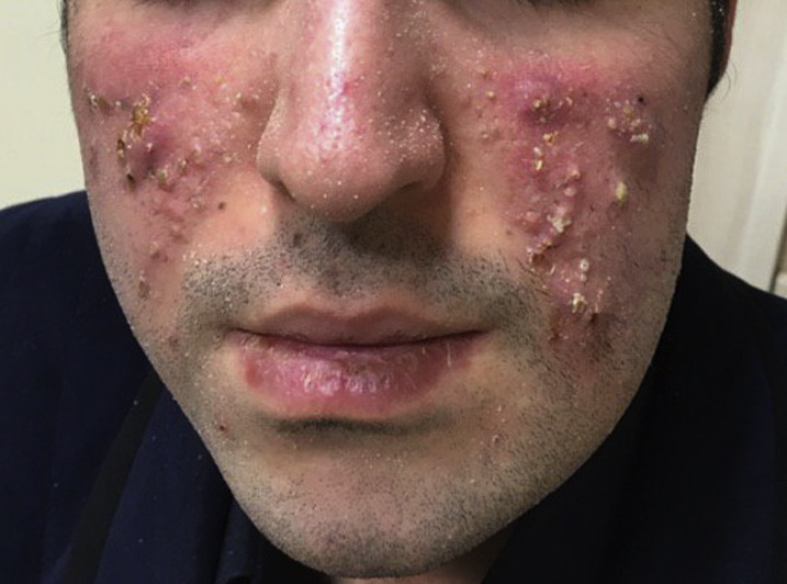 skin and skin structure morganella morganii infection