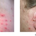 skin and skin structure peptococcus infection