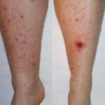 skin and skin structure proteus infection