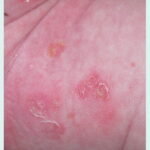 skin and skin structure providencia infection