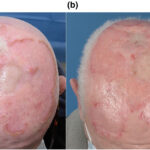 skin and skin structure serratia infection