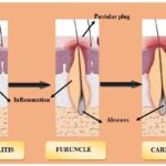 skin and skin structure staphylococcus infection
