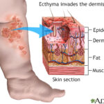 skin and skin structure streptococcus infection