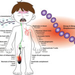 skin and skin structure streptococcus pyogenes infection