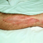 skin grafting adjunct