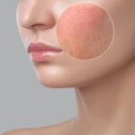 skin inflammation
