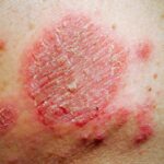 skin irritation