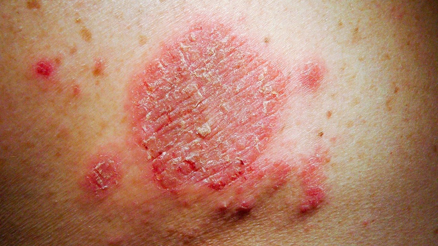 skin irritation