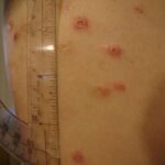 skin ulcer
