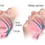 sleepiness due to obstructive sleep apnea