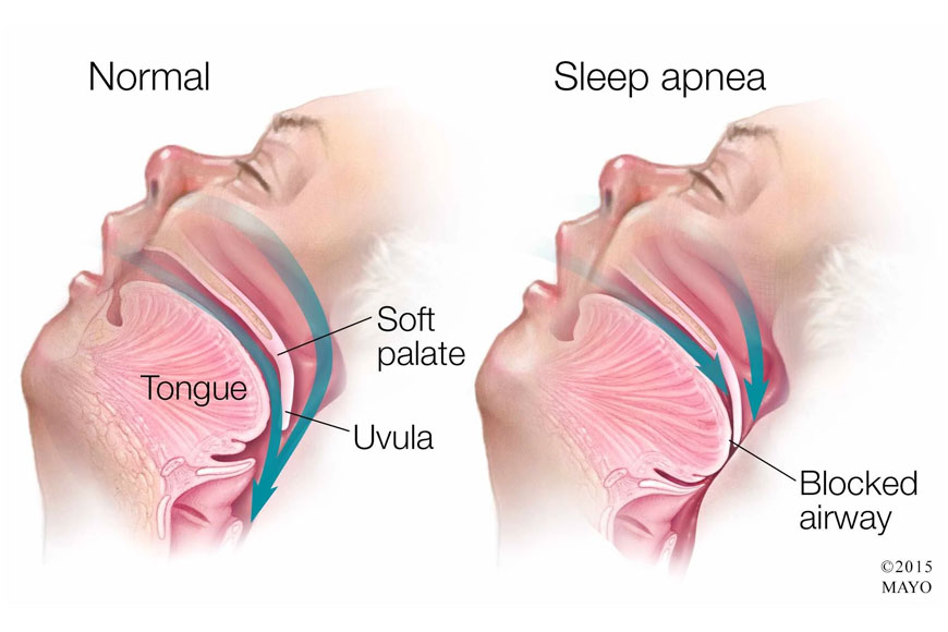 sleepiness due to obstructive sleep apnea