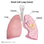small cell lung carcinoma