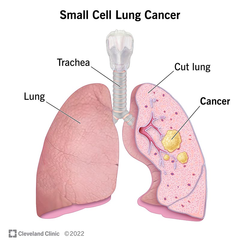 small cell lung carcinoma