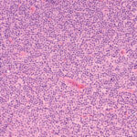small lymphocytic lymphoma