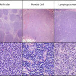 small lymphocytic lymphoma with 17p deletion