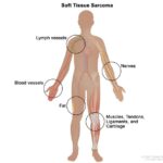 soft or connective tissue sarcoma