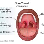 sore throat