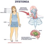 spasmodic torticollis