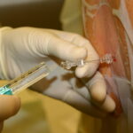 spinal anesthesia