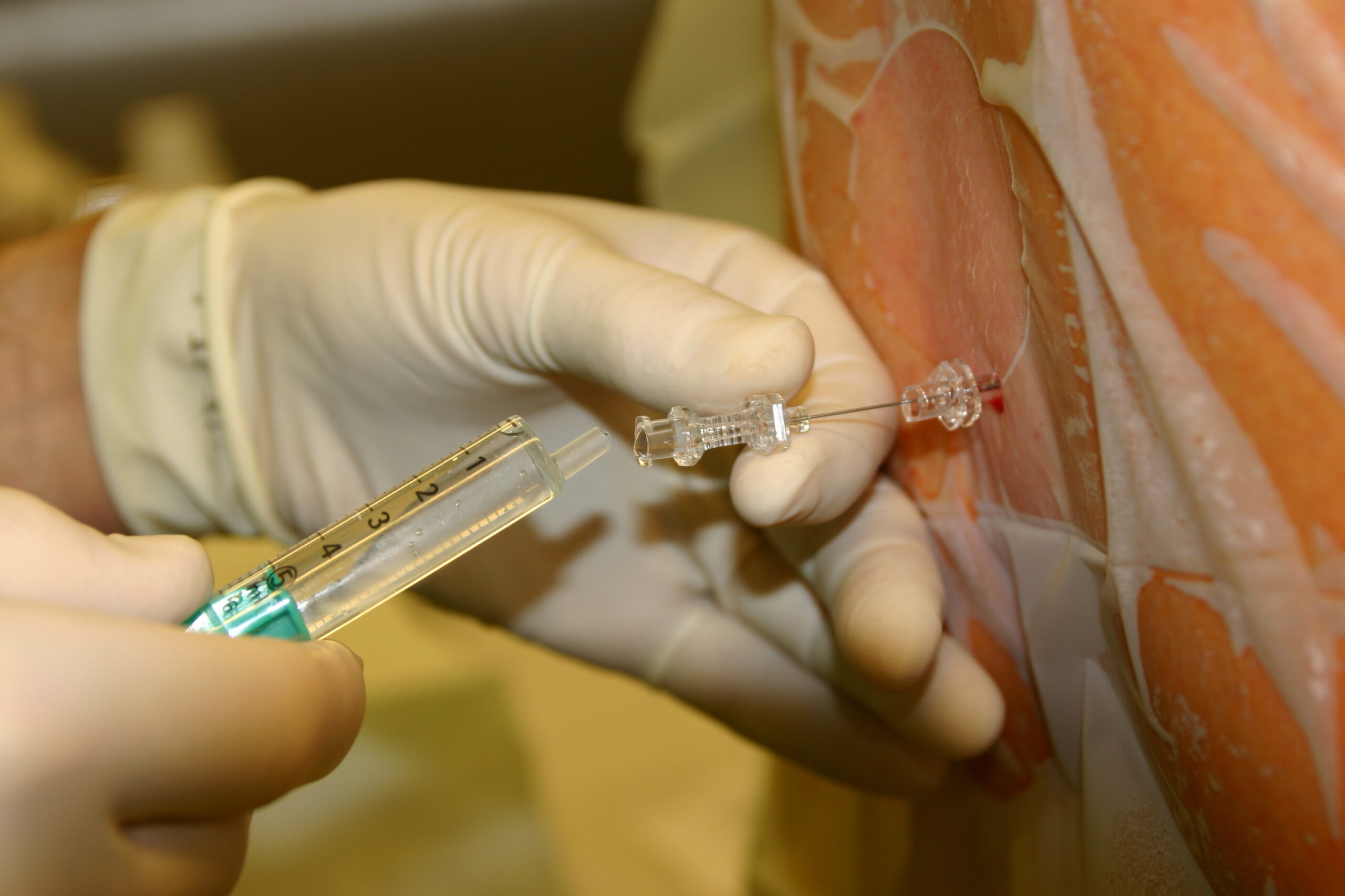 spinal anesthesia
