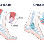 sprains and strains