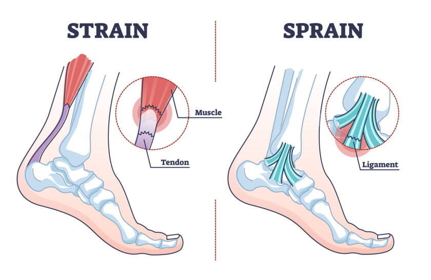 sprains and strains