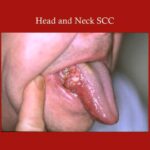 squamous cell carcinoma of head and neck