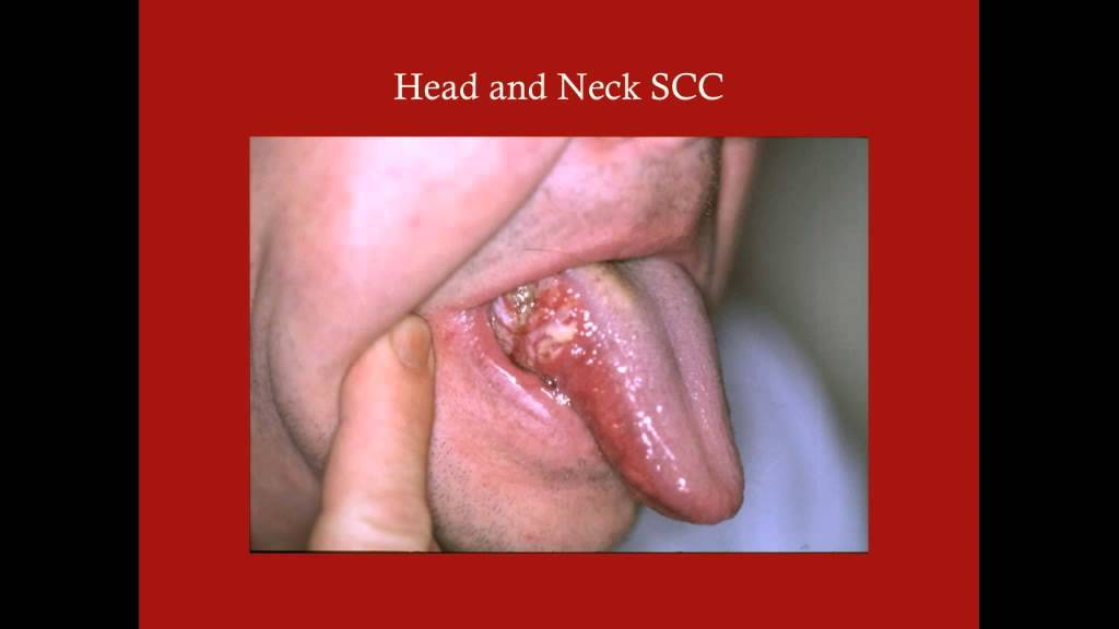 squamous cell carcinoma of head and neck