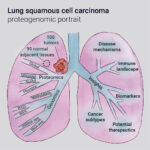 squamous cell carcinoma of lung