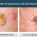 squamous cell carcinoma of skin