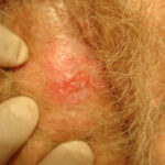 squamous cell carcinoma of vulva