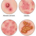 staph aureus traumatic skin lesion infection