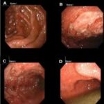 staphylococcal enterocolitis