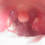 staphylococcal pharyngitis