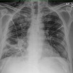staphylococcal pneumonia