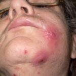 staphylococcal septicemia