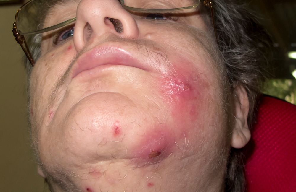 staphylococcal septicemia