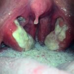 staphylococcal tonsillitis
