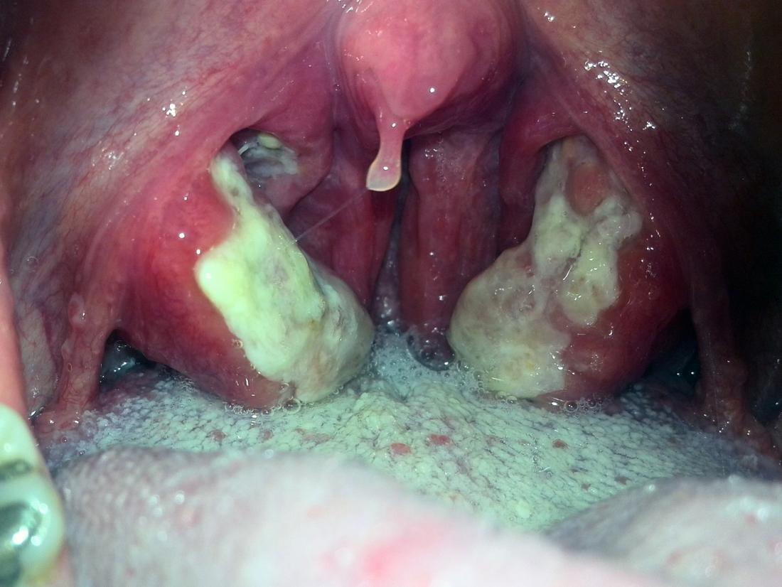 staphylococcal tonsillitis