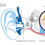 staphylococcus acute otitis media