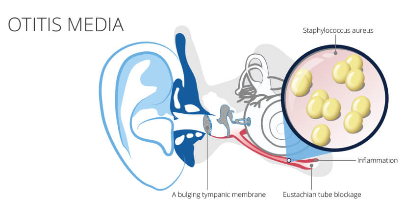 staphylococcus acute otitis media