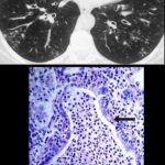 staphylococcus aureus bronchitis