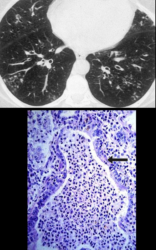 staphylococcus aureus bronchitis