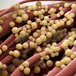 staphylococcus aureus septicemia