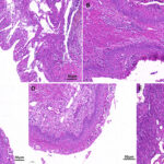 staphylococcus endometritis