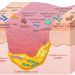 staphylococcus epidermidis skin and skin structure infection