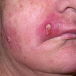 staphylococcus infections