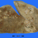 staphylococcus lung abscess